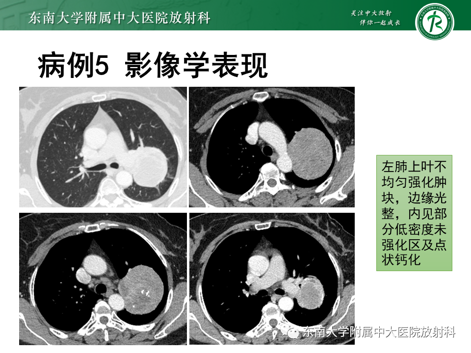 影像PPT - 【PPT】胸膜孤立性纤维瘤-32 影像PPT - 【PPT】胸膜孤立性纤维瘤-32
