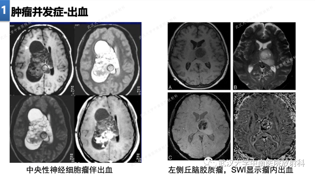 影像PPT - 【PPT】局灶性脑部病变影像学诊断-8