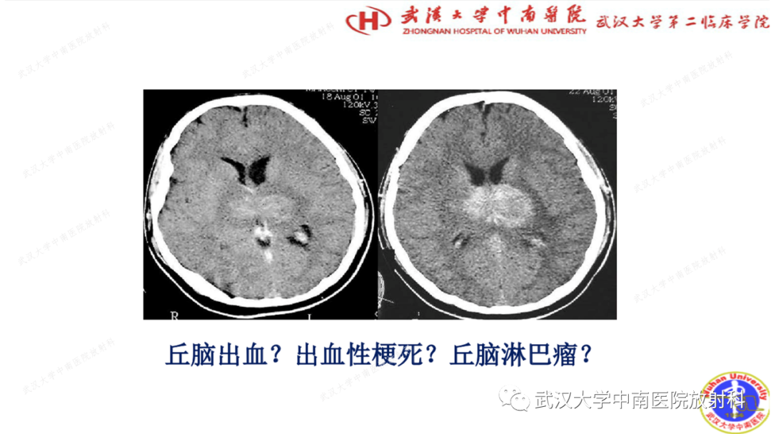 影像PPT - 【PPT】局灶性脑部病变影像学诊断-2