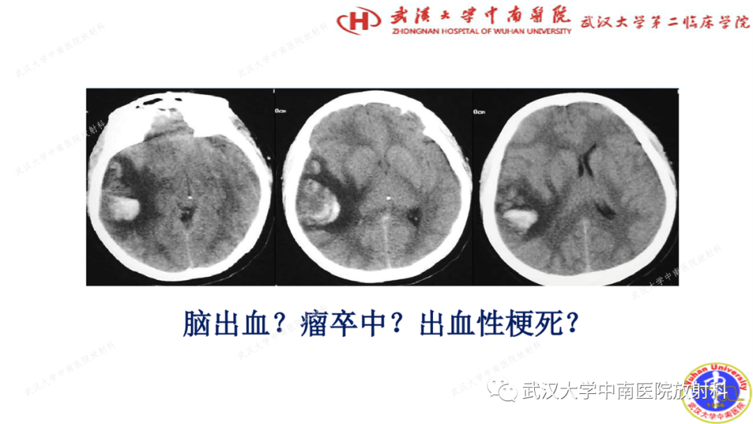 影像PPT - 【PPT】局灶性脑部病变影像学诊断-3