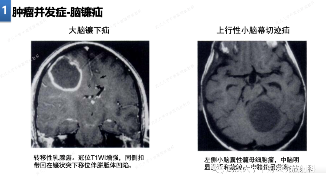 影像PPT - 【PPT】局灶性脑部病变影像学诊断-9