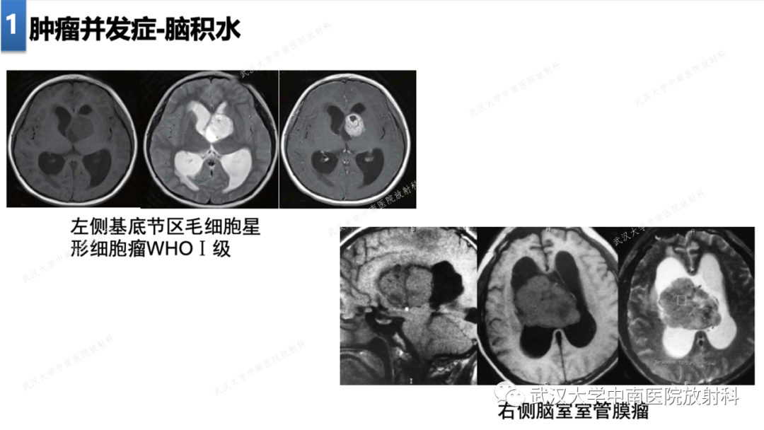 影像PPT - 【PPT】局灶性脑部病变影像学诊断-10