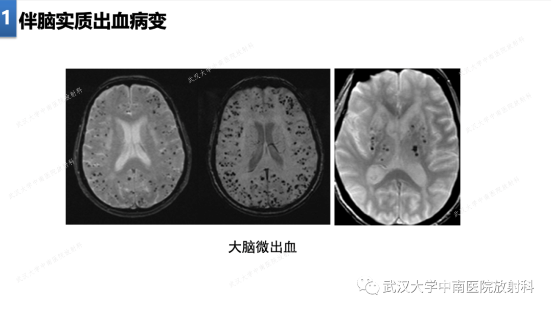 影像PPT - 【PPT】局灶性脑部病变影像学诊断-12