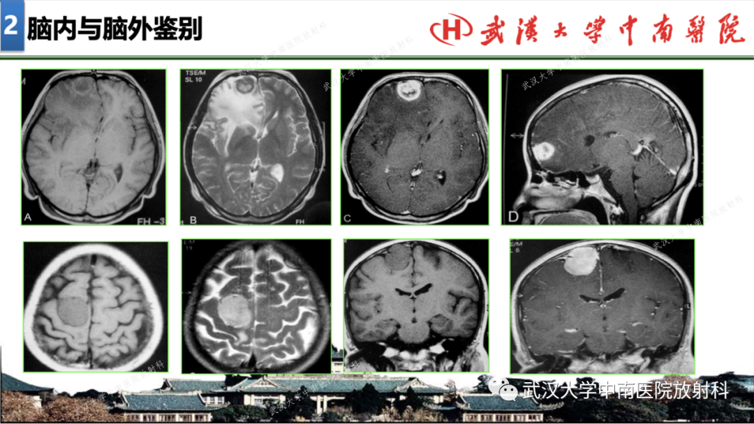 影像PPT - 【PPT】局灶性脑部病变影像学诊断-14