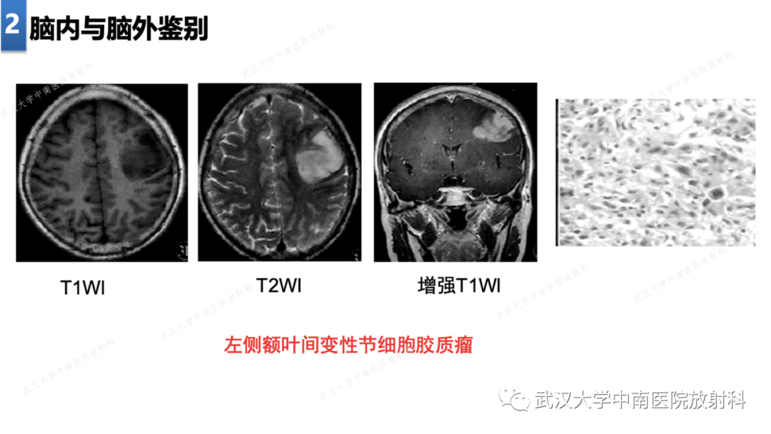 影像PPT - 【PPT】局灶性脑部病变影像学诊断-15