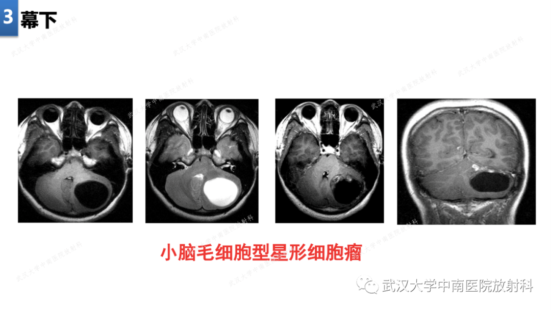 影像PPT - 【PPT】局灶性脑部病变影像学诊断-18