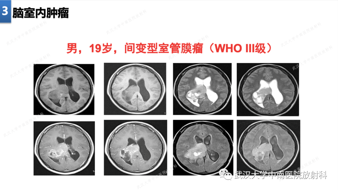 影像PPT - 【PPT】局灶性脑部病变影像学诊断-19