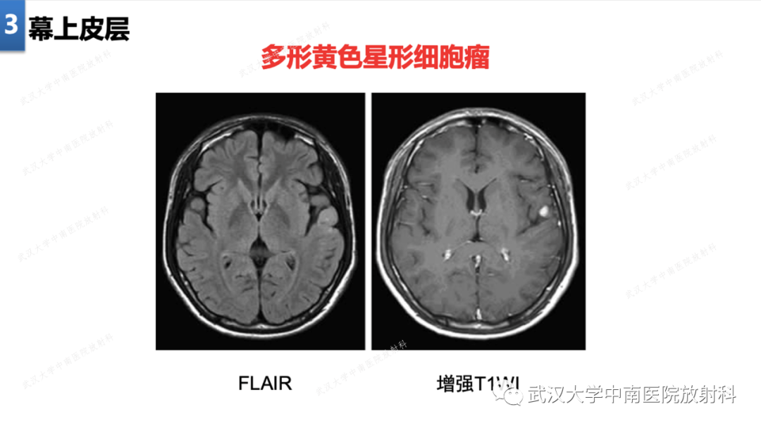 影像PPT - 【PPT】局灶性脑部病变影像学诊断-20