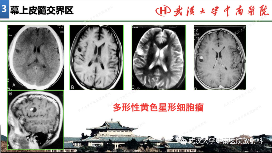 影像PPT - 【PPT】局灶性脑部病变影像学诊断-21