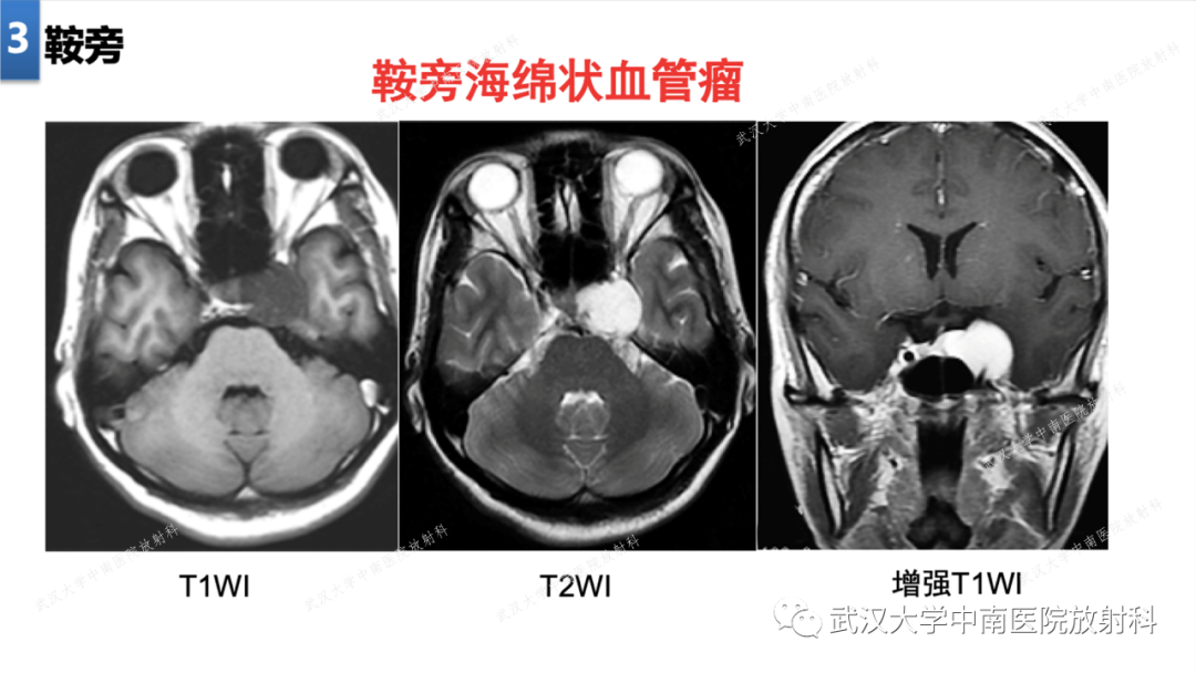 影像PPT - 【PPT】局灶性脑部病变影像学诊断-22