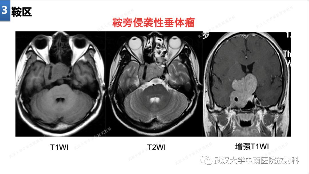 影像PPT - 【PPT】局灶性脑部病变影像学诊断-23