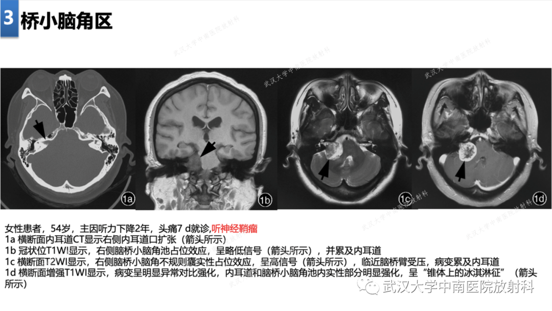影像PPT - 【PPT】局灶性脑部病变影像学诊断-24