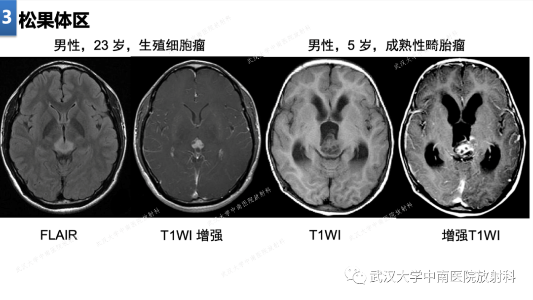 影像PPT - 【PPT】局灶性脑部病变影像学诊断-25