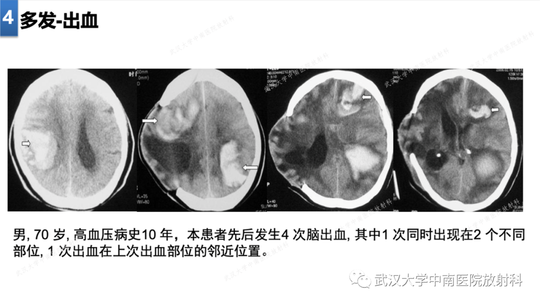 影像PPT - 【PPT】局灶性脑部病变影像学诊断-27