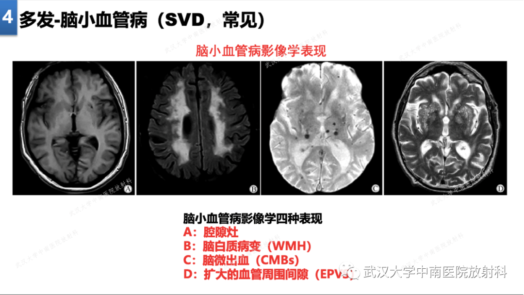 影像PPT - 【PPT】局灶性脑部病变影像学诊断-28