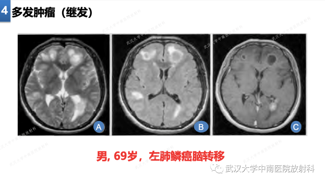 影像PPT - 【PPT】局灶性脑部病变影像学诊断-29