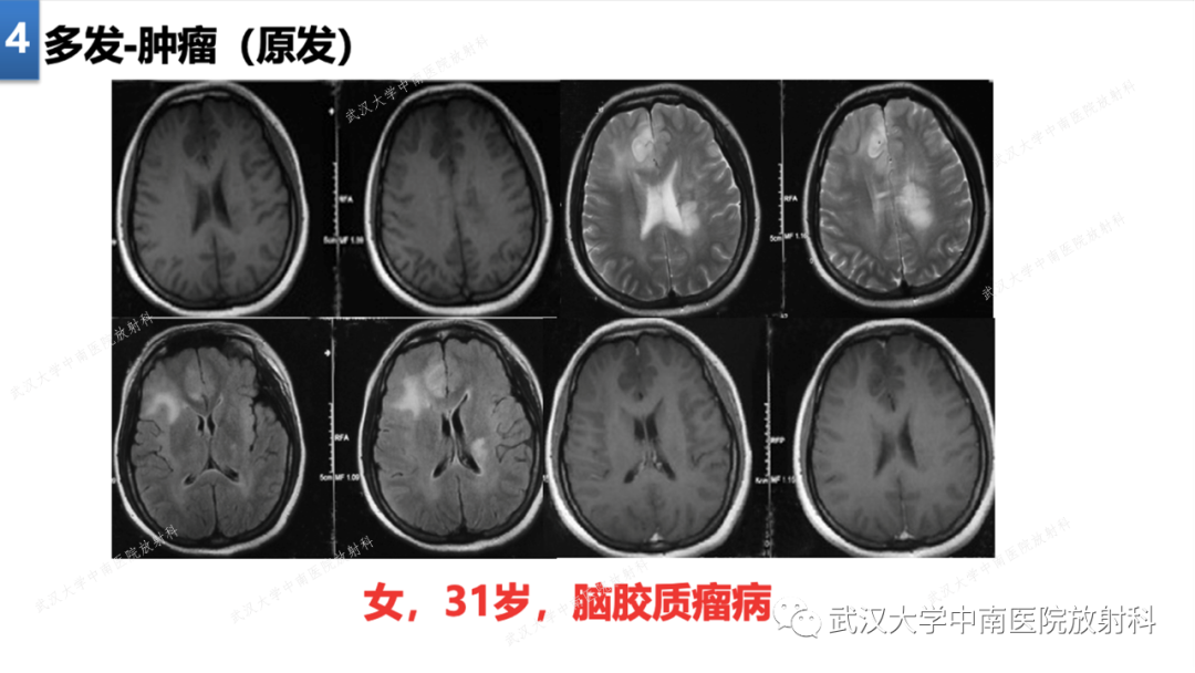 影像PPT - 【PPT】局灶性脑部病变影像学诊断-30
