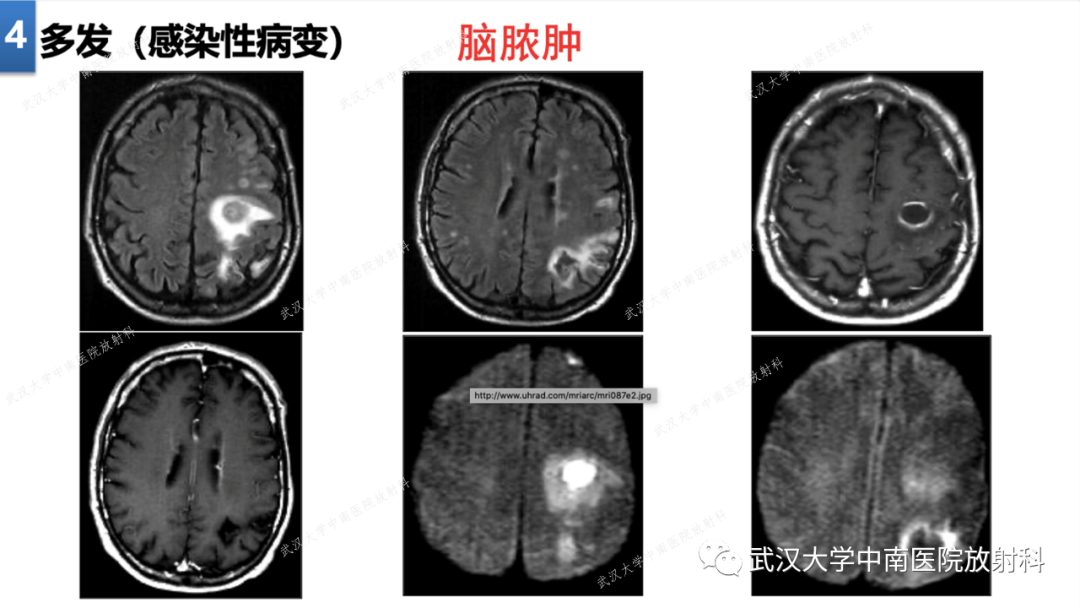 影像PPT - 【PPT】局灶性脑部病变影像学诊断-31