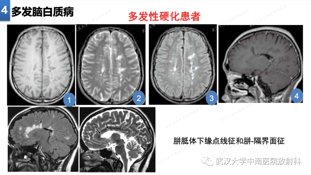 影像PPT - 【PPT】局灶性脑部病变影像学诊断-32