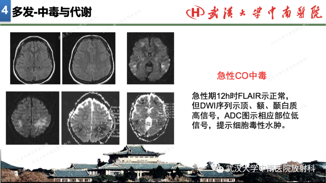 影像PPT - 【PPT】局灶性脑部病变影像学诊断-34