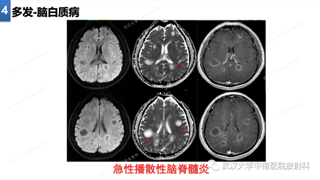 影像PPT - 【PPT】局灶性脑部病变影像学诊断-33