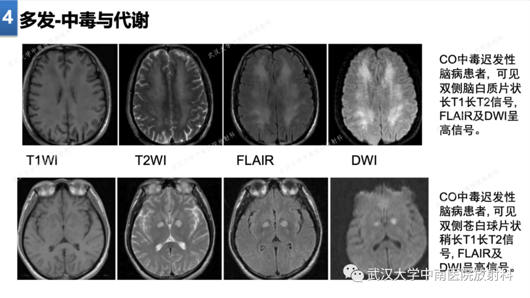 影像PPT - 【PPT】局灶性脑部病变影像学诊断-35
