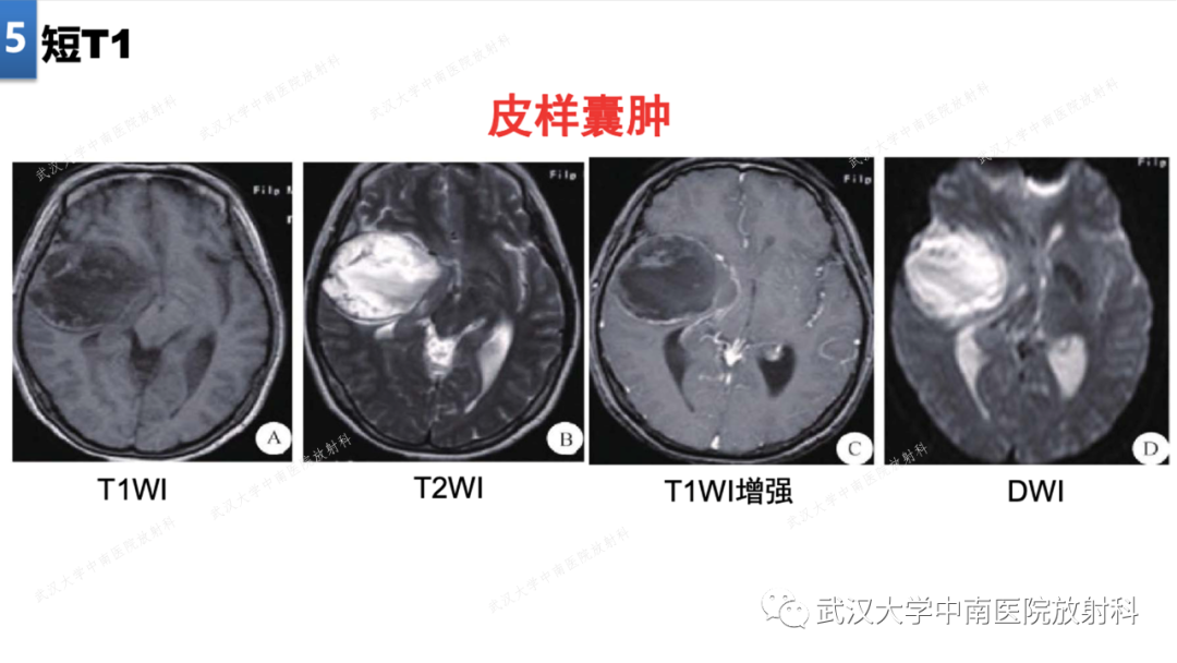 影像PPT - 【PPT】局灶性脑部病变影像学诊断-37