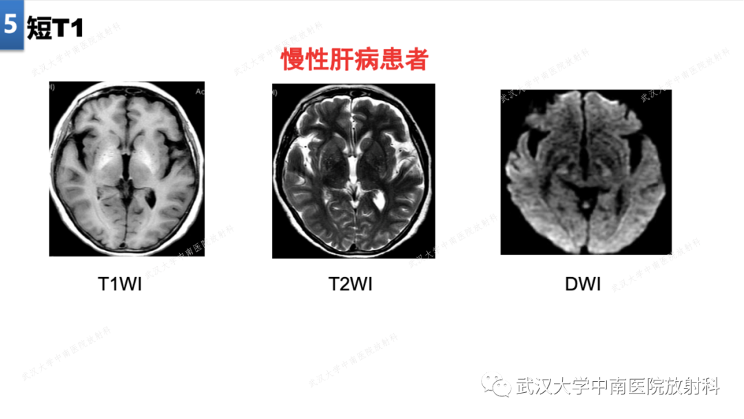 影像PPT - 【PPT】局灶性脑部病变影像学诊断-38