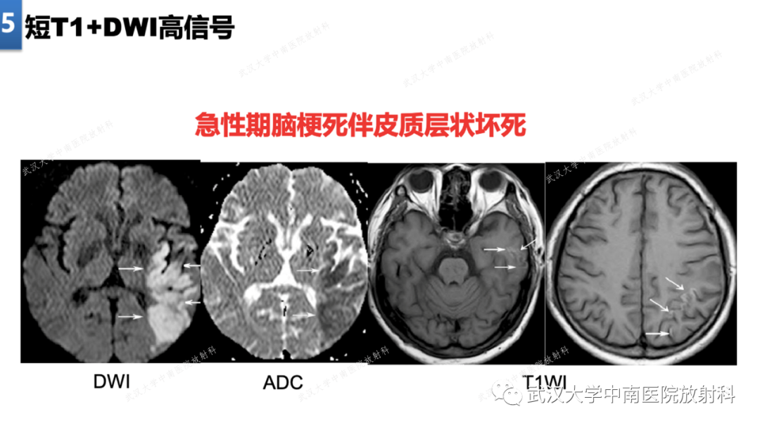 影像PPT - 【PPT】局灶性脑部病变影像学诊断-39