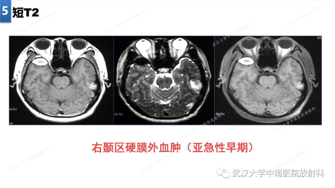 影像PPT - 【PPT】局灶性脑部病变影像学诊断-40
