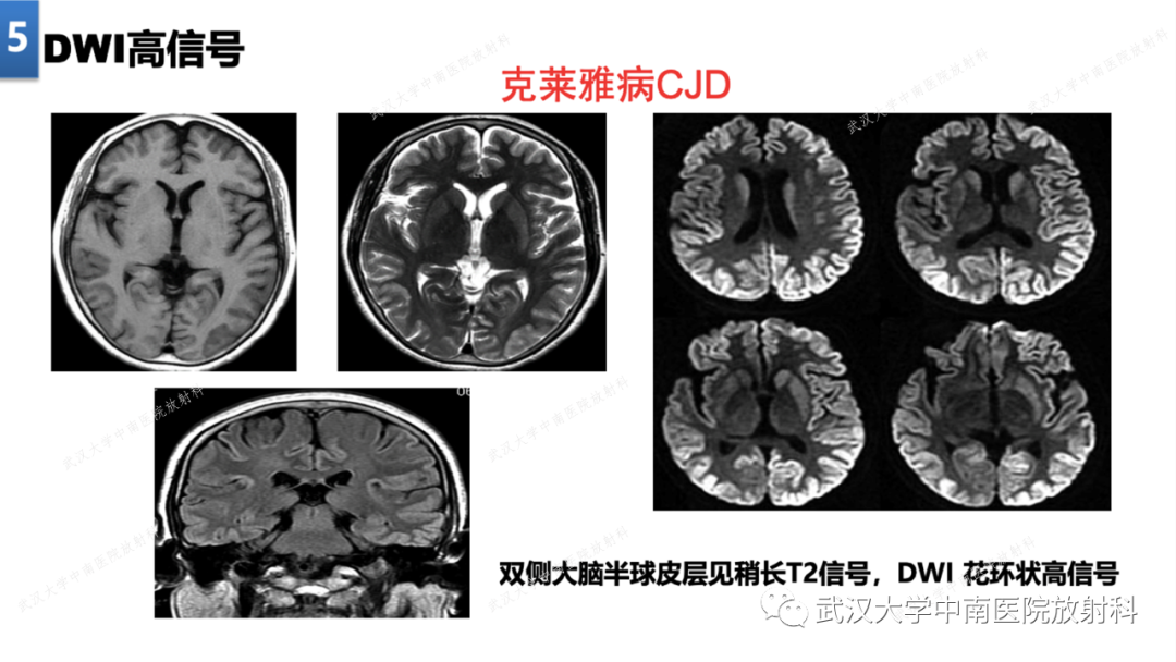 影像PPT - 【PPT】局灶性脑部病变影像学诊断-42