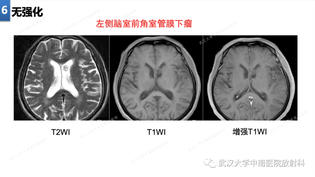 影像PPT - 【PPT】局灶性脑部病变影像学诊断-44