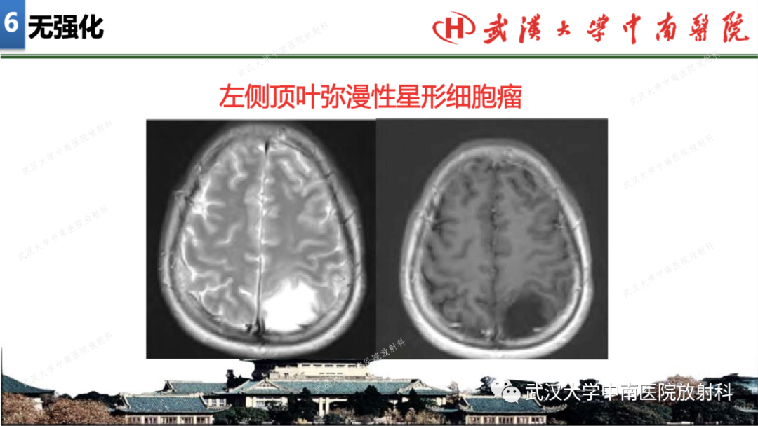 影像PPT - 【PPT】局灶性脑部病变影像学诊断-45