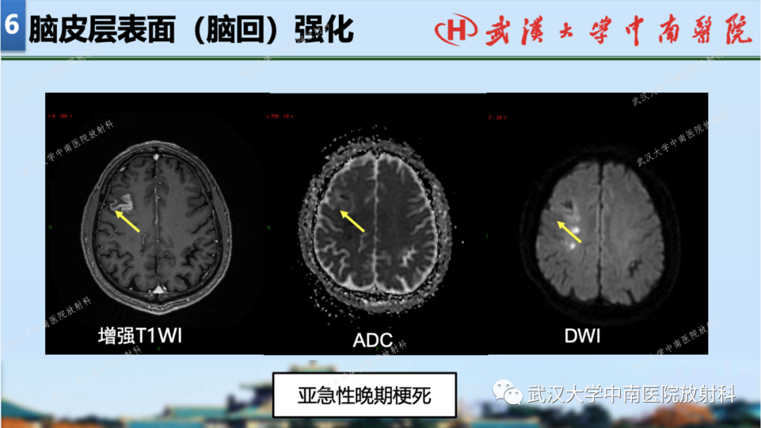 影像PPT - 【PPT】局灶性脑部病变影像学诊断-48