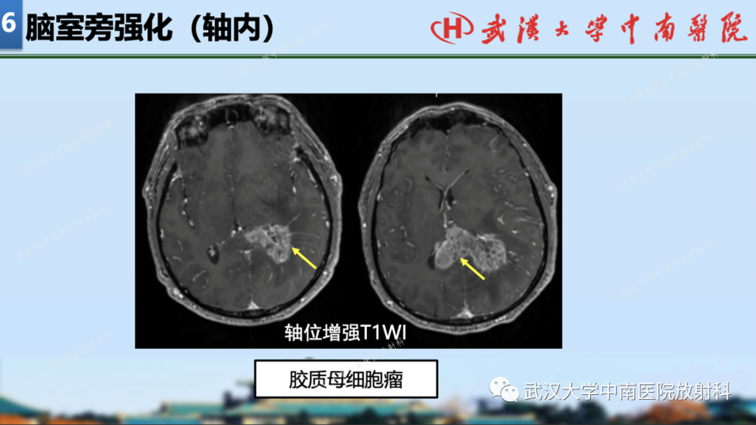 影像PPT - 【PPT】局灶性脑部病变影像学诊断-52
