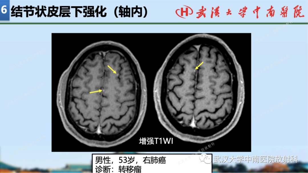 影像PPT - 【PPT】局灶性脑部病变影像学诊断-54