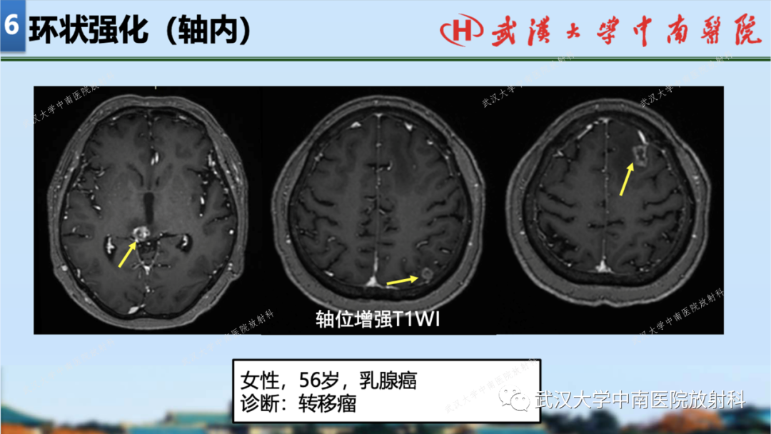 影像PPT - 【PPT】局灶性脑部病变影像学诊断-57