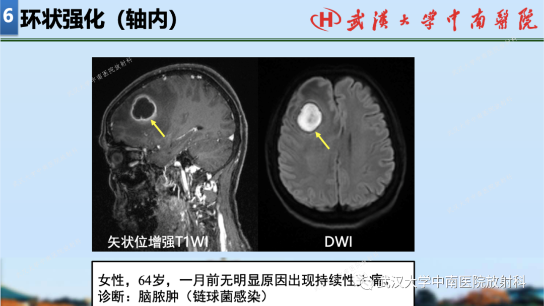 影像PPT - 【PPT】局灶性脑部病变影像学诊断-58