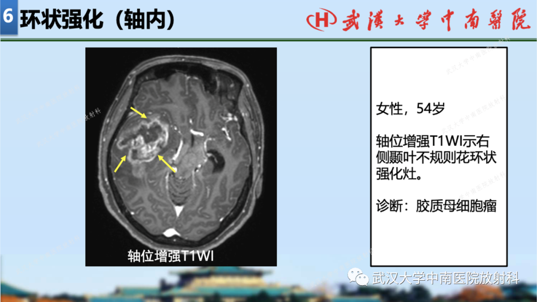 影像PPT - 【PPT】局灶性脑部病变影像学诊断-59