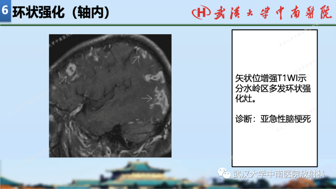 影像PPT - 【PPT】局灶性脑部病变影像学诊断-60