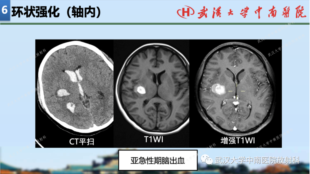 影像PPT - 【PPT】局灶性脑部病变影像学诊断-61
