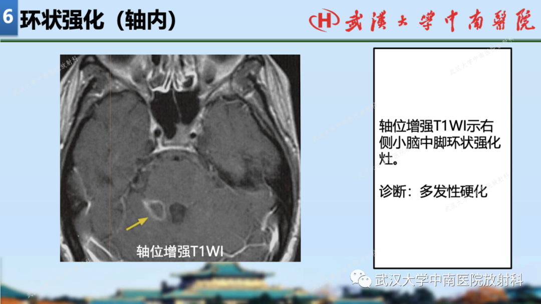 影像PPT - 【PPT】局灶性脑部病变影像学诊断-62