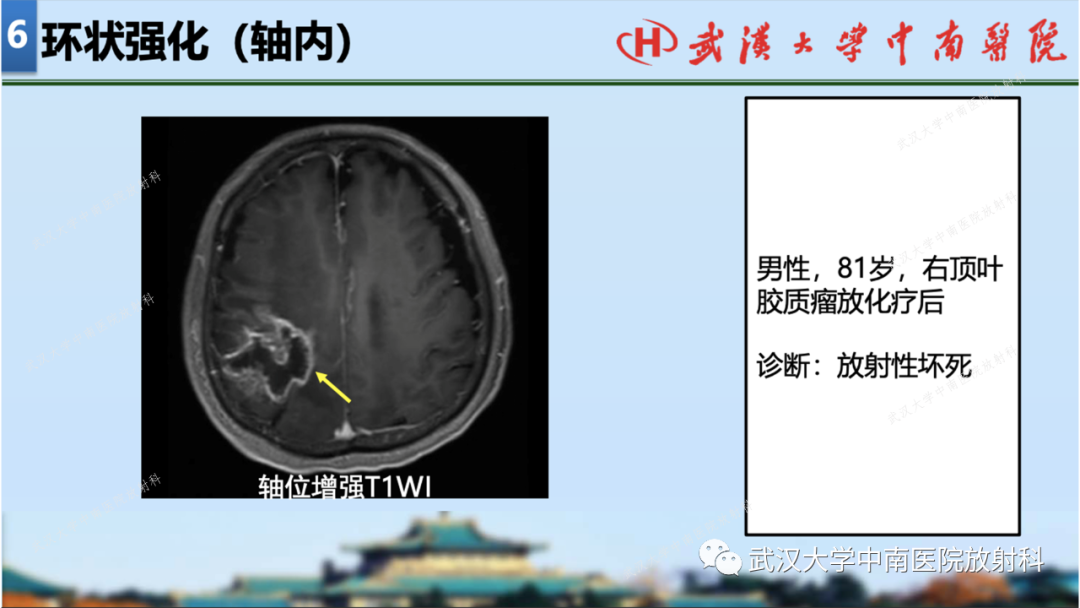 影像PPT - 【PPT】局灶性脑部病变影像学诊断-63