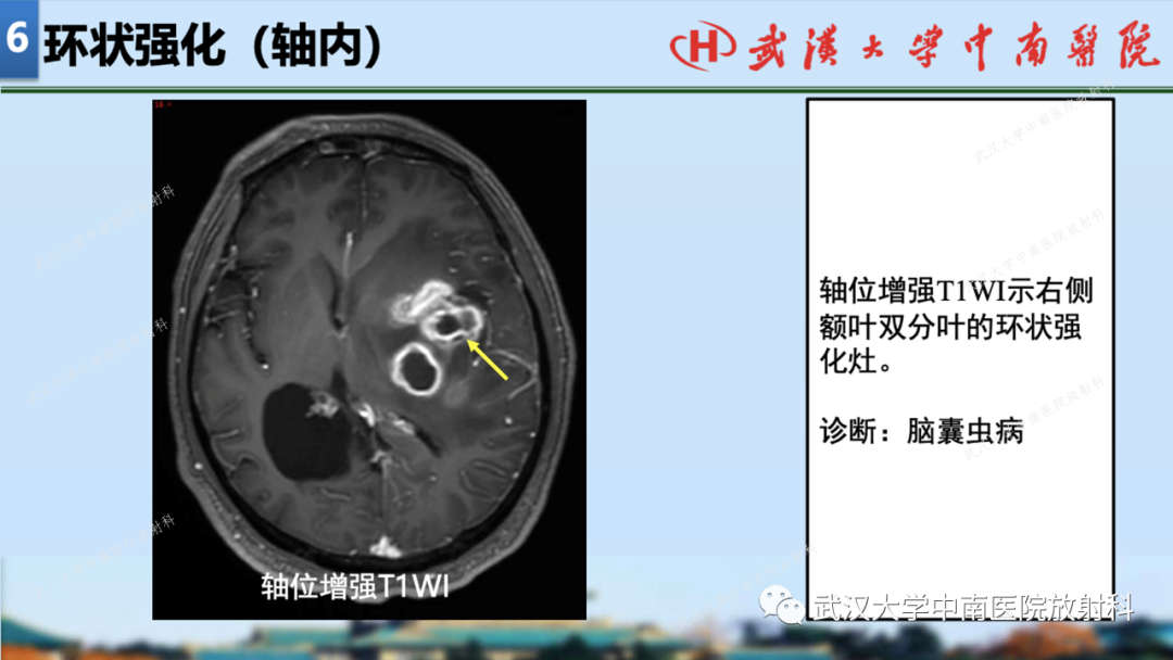 影像PPT - 【PPT】局灶性脑部病变影像学诊断-64