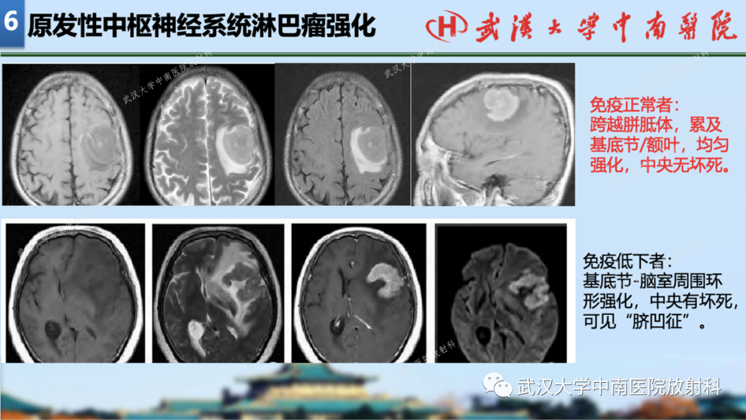 影像PPT - 【PPT】局灶性脑部病变影像学诊断-65