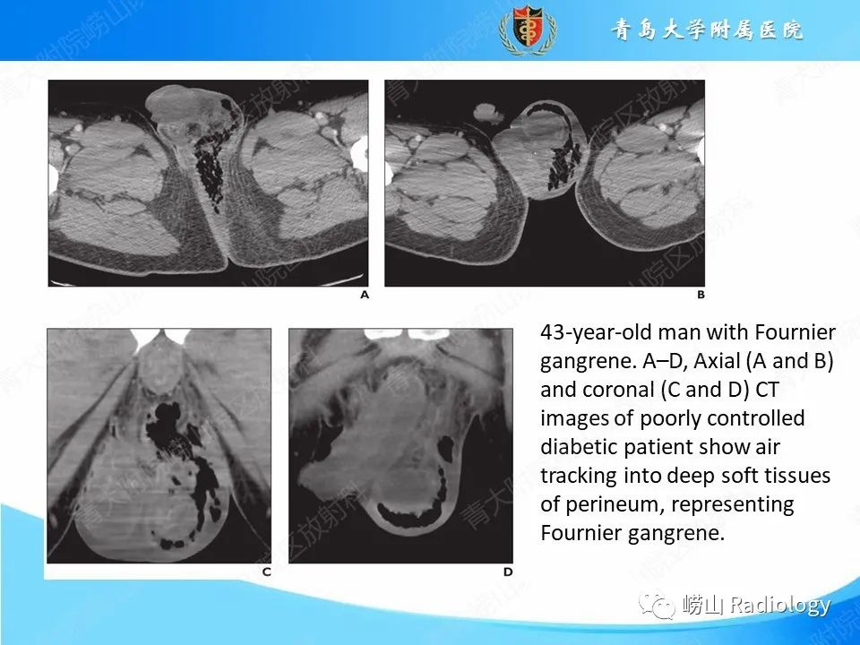 影像PPT - 【PPT】坏死性筋膜炎-12