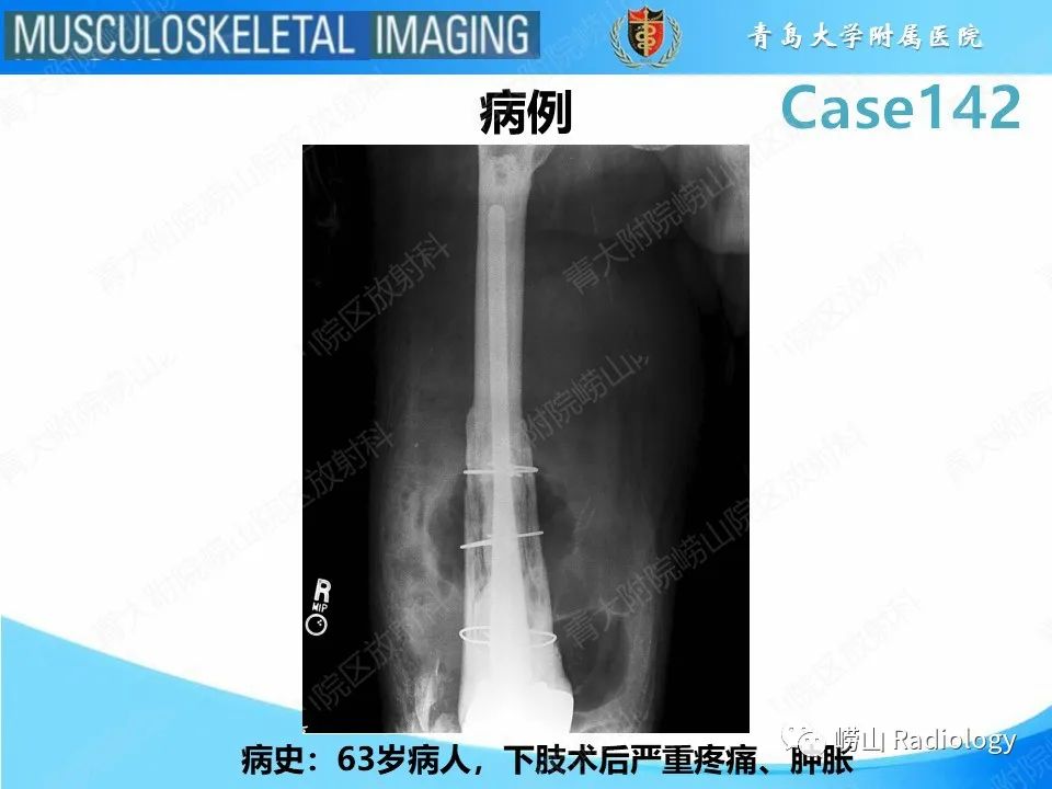 影像PPT - 【PPT】坏死性筋膜炎-2
