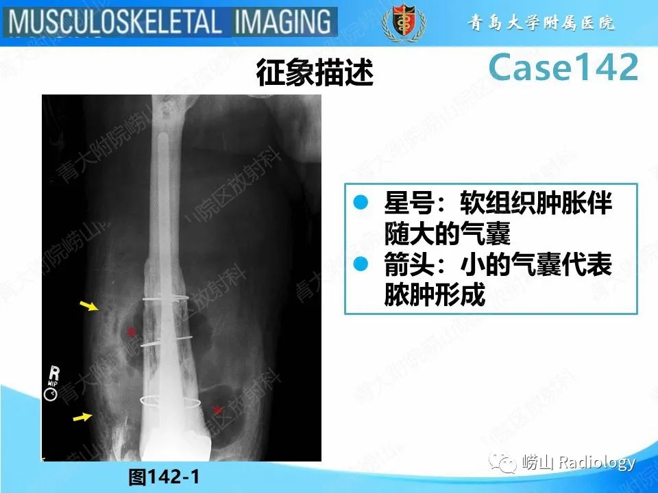 影像PPT - 【PPT】坏死性筋膜炎-13