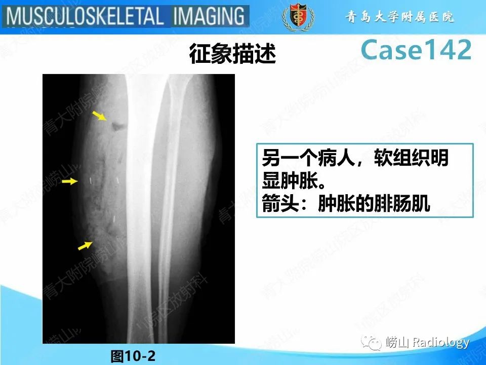 影像PPT - 【PPT】坏死性筋膜炎-14