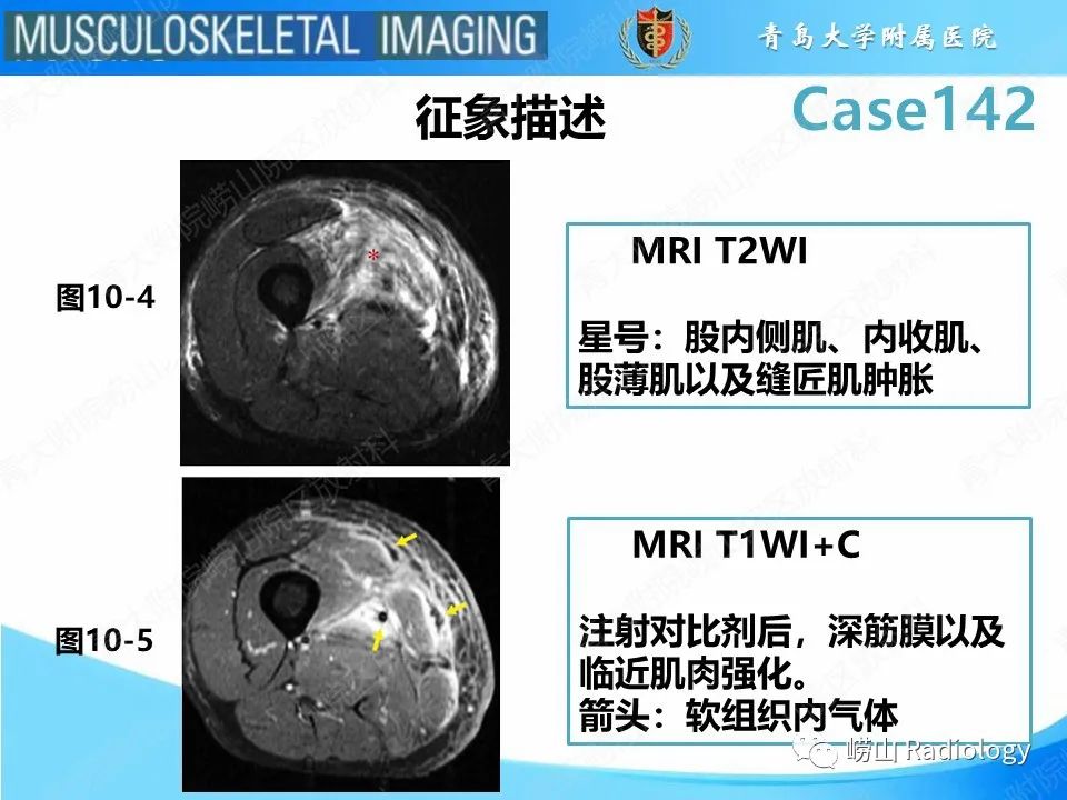 影像PPT - 【PPT】坏死性筋膜炎-16